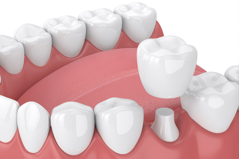 Dental Crowns in Greybull