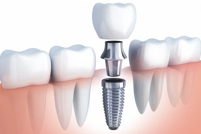 Implants Dentist in Greybull