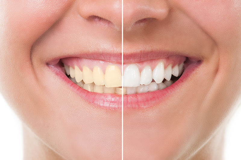 Teeth Whitening in Greybull