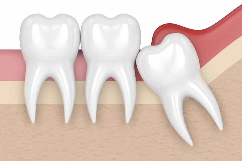 Wisdom Tooth Removal in Greybull
